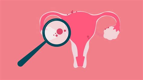 Endometriose conheça as causas os sintomas e os tratamentos