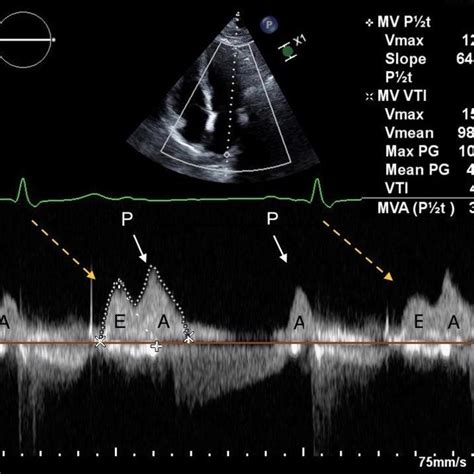 Top Echocardiographic Image Showed Pulsed Wave Doppler Of Mitral