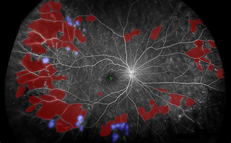 Dr Using Ultra Widefield Fluorescein Angiography Opth