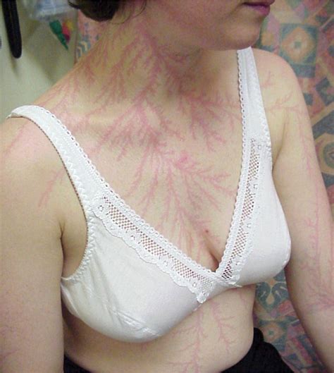 Lightning Scars Imgur