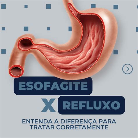 Entenda As Diferen As Entre Esofagite E Refluxo