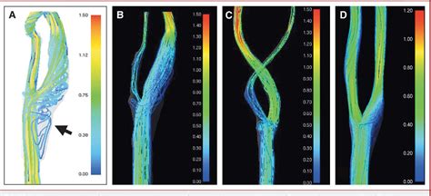 Figure 1 From Computational Fluid Dynamics Of Carotid Arteries After Carotid Endarterectomy Or