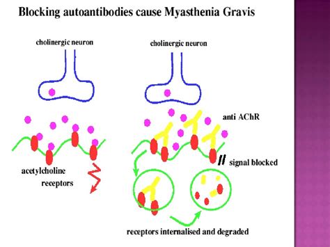 Pathophysiology Of Myasthenia Gravis Schematic Diagram