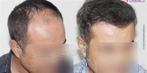 Explain The Things To Avoid After Hair Transplant Surgery