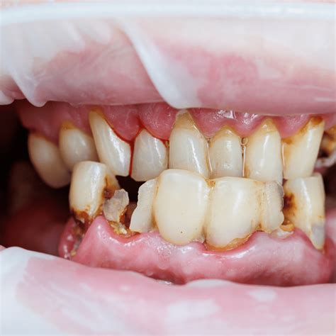 Swollen Gums Causes Symptoms And Treatment Best Dental Clinic In