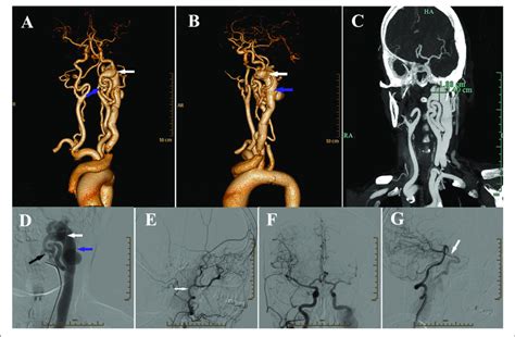 A Anteroposterior View Of Three Dimensional Volume Rendering Of