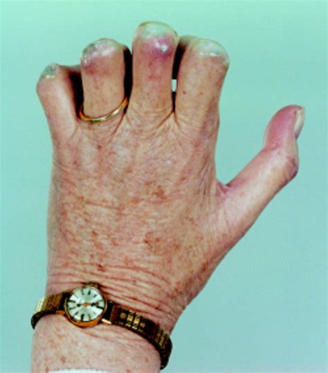 Treatment Of Cutaneous Calcinosis In Limited Systemic Sclerosis With