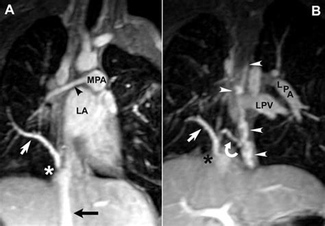 Scimitar Syndrome With Esophageal Varices Circulation