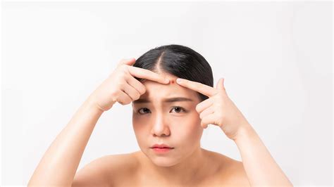 Acne Vulgaris Raffles Skin And Aesthetics Centre Singapore