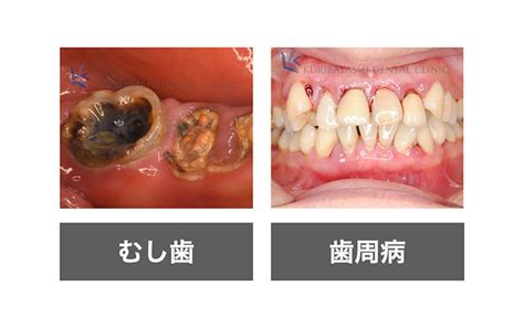 Q むし歯と歯周病の違いって何？ 新浦安の歯医者・歯科｜栗林歯科医院｜各専門医在籍