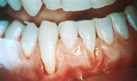 5 Ways That Gum Recession Can Be Reversed Shine Dental Associates