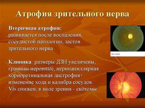 Заболевания зрительного нерва - презентация онлайн