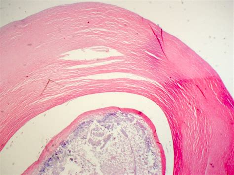 Pathology Outlines Infarcted Epiploic Appendages