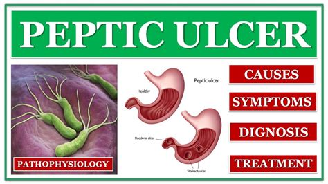 Peptic Ulcer Causes Sign And Symptoms Diagnosis Pathophysiology Types Treatment Of