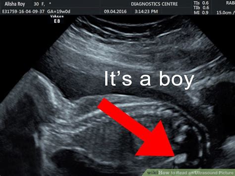 How To Read An Ultrasound Picture 9 Steps With Pictures