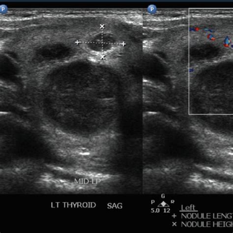 Thyroid ultrasound performed postoperatively revealing multiple thyroid ...