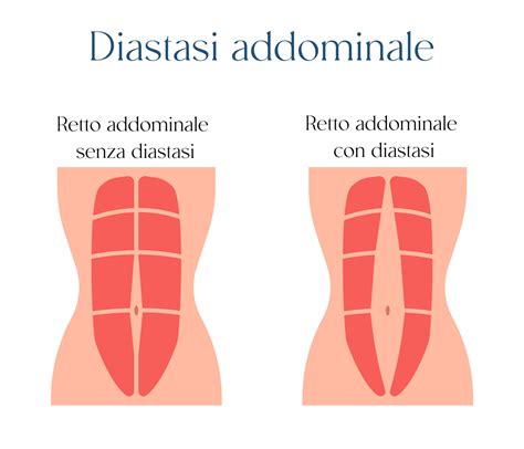 Diastasi Addominale Cos Cause Sintomi E Cure Guida Completa