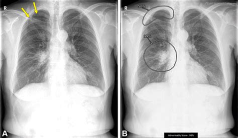 Deep Learning For Detecting Pneumothorax On Chest