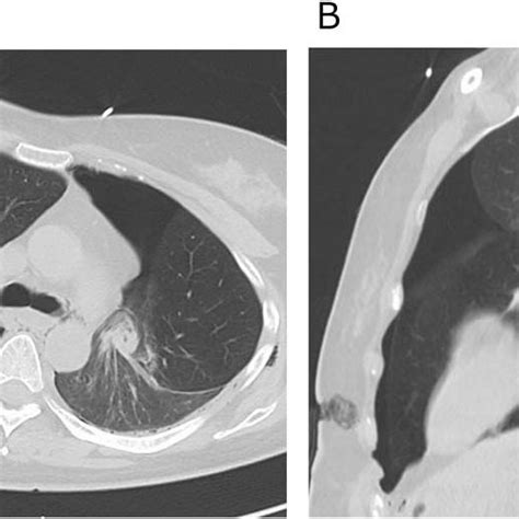 Axial A And Sagittal B Computed Tomography Images Few Hours After Download Scientific