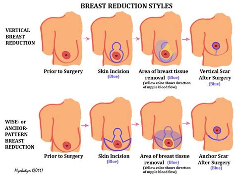 Boob Reduction Surgery Telegraph