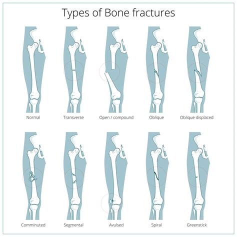 Types Of Bone Fractures Chart