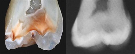 Diagnosis Dental Caries Dentine Caries