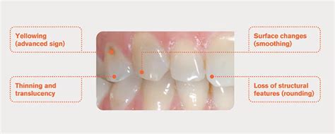 Healthy Teeth Vs. Acid Erosion & Wear – Britten Perio