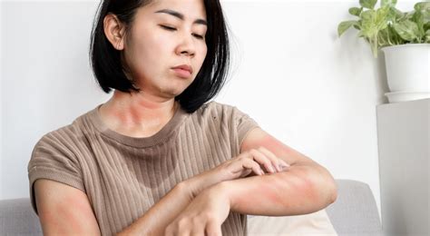 Hives — Common Symptoms Treatments And More