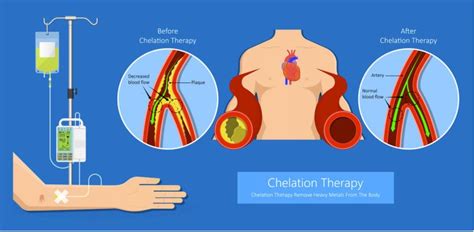 Iv Chelation Therapy Louisville Ky Iv Therapy Near Me