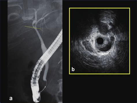 A Ercp Showing The Pressure Excursion Of The Bile Duct B Idus Download Scientific Diagram