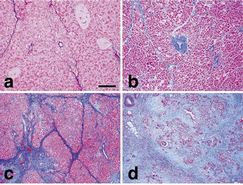 Significance Of Histopathological Evaluation Of Pancreatic Fibrosis To