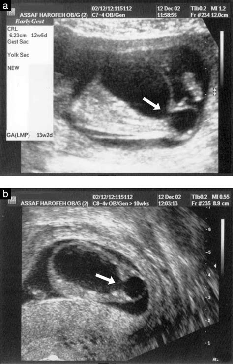 Is There An Increased Rate Of Megacystis In Twins Maymon 2005