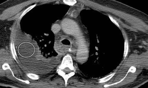 Pleural Effusion Characterization With Ct Attenuation Values And Ct Appearance Ajr