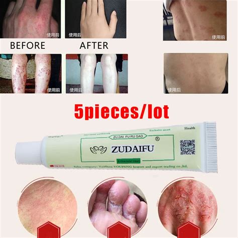 5pcslot Zudaifu Eczema Pruritus Psoriasis Ointment Herbal Cream