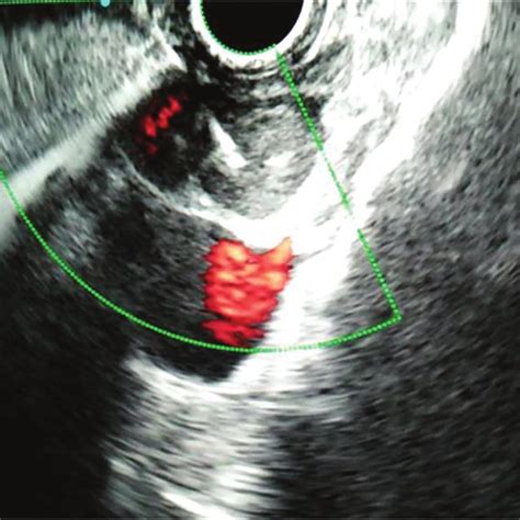 Portacaval Lymph Nodes