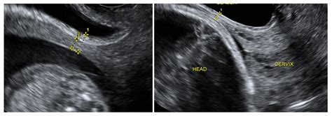 Medicina Free Full Text Cesarean Scar Thickness Decreases During