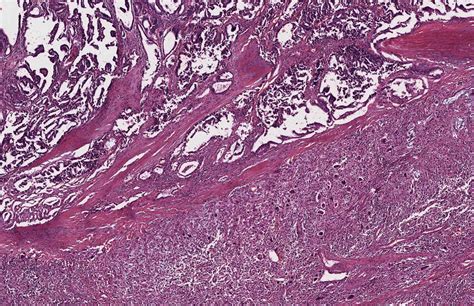 Pathology Outlines Anaplastic Thyroid Carcinoma