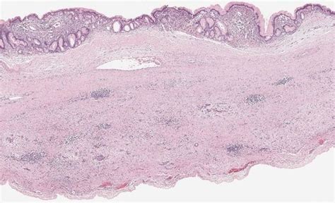 Cystic Lesions Of The Pancreas Alchetron The Free Social Encyclopedia