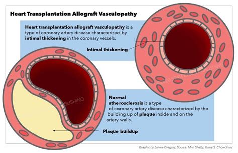 Figure Heart Transplantation Allograft Vasculopathy Heart