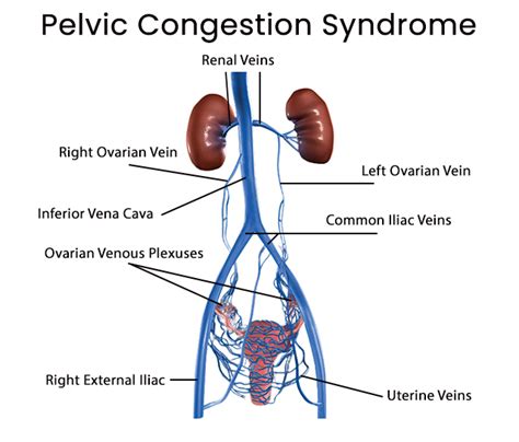 Prominent Pelvic Veins