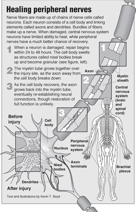 Nerve Damage Pointfinder Health Infographics