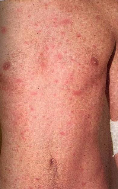 HIV Rash - Pictures, Symptoms, Treatment, Diagnoses | Diseases Pictures