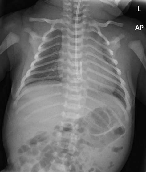 Pediatric Nasogastric Tube Malfunction Malposition 40 Off