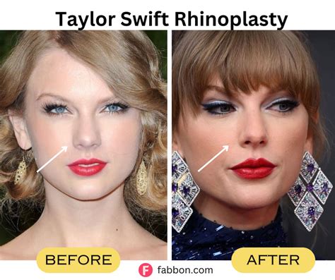 All 7 Plastic Surgeries Taylor Swift Underwent As Per Medical Experts