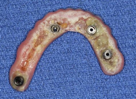 Correct Design Of Fixed Implant Bridges All On 4 To Allow Proper Cleaning Dental Implant Center