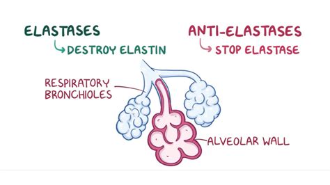 Solution Enfermedad Pulmonar Obstructiva Cronica Epoc Studypool