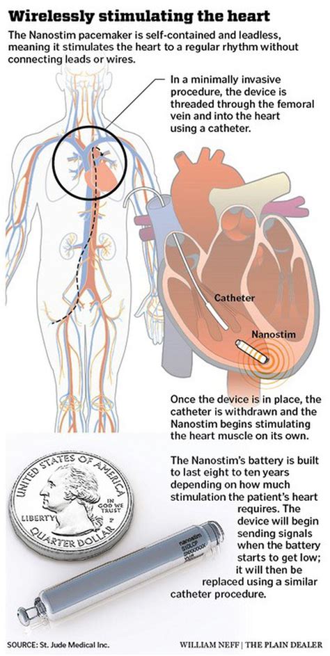 Tiny Wireless Pacemaker Implanted At Cleveland Clinic Is First In Ohio