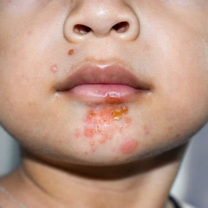 Impetigo Burnett Dermatology