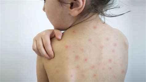 Morbillo Boom Di Casi In Italia L Allarme Degli Scienziati