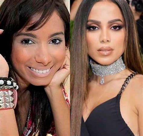 Confira o Antes e Depois das cirurgias plásticas de 15 famosas